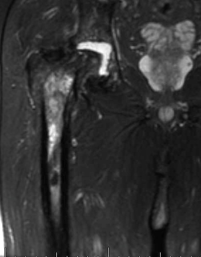 Proximal Femur Osteomyelitis MRi 2